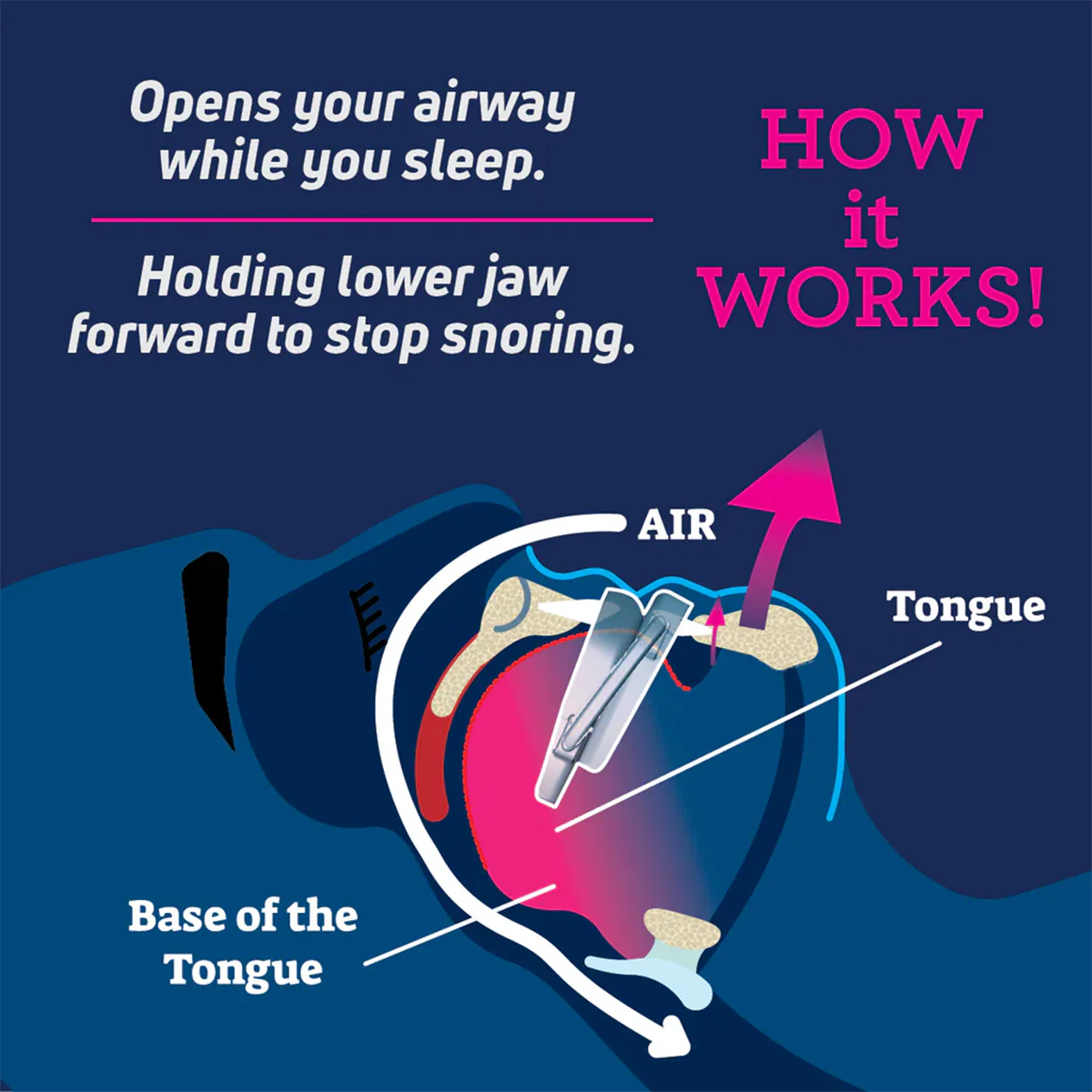 SmartGuard Anti-Snore Device - Image 4